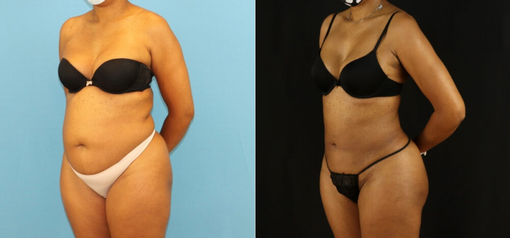 Brazilian Butt Lift case #5115