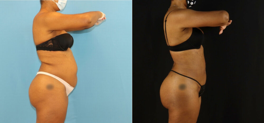 Brazilian Butt Lift case #5115