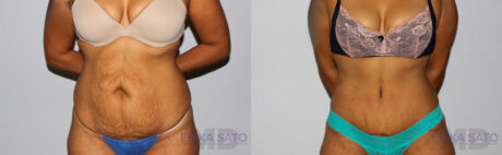 Tummy Tuck case #7092