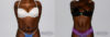 Tummy Tuck case #7163 slider thumbnail