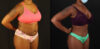 Tummy Tuck case #7282 slider thumbnail