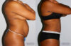 Tummy Tuck case #7096 slider thumbnail