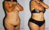 Tummy Tuck case #7095 slider thumbnail