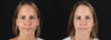 Botox® & Other Neuromodulators case #5064 slider thumbnail
