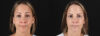 Botox® & Other Neuromodulators case #5064 slider thumbnail
