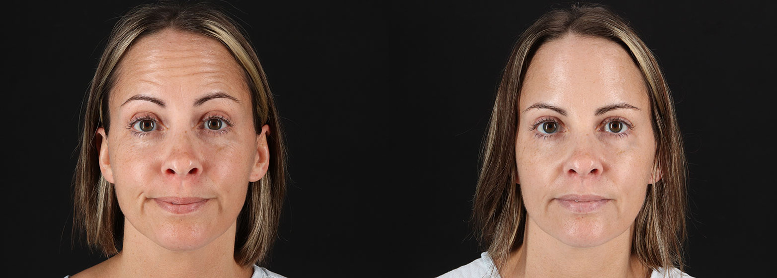 Botox-Before-and-After-photo-by-Dr.-Abigail-Rodriguez-in-Houston-TX-258578-2