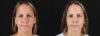 Botox® & Other Neuromodulators case #5064 slider thumbnail