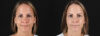 Botox® & Other Neuromodulators case #5064 slider thumbnail