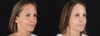 Botox® & Other Neuromodulators case #5064 slider thumbnail