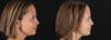 Botox® & Other Neuromodulators case #5064 slider thumbnail