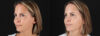 Botox® & Other Neuromodulators case #5064 slider thumbnail