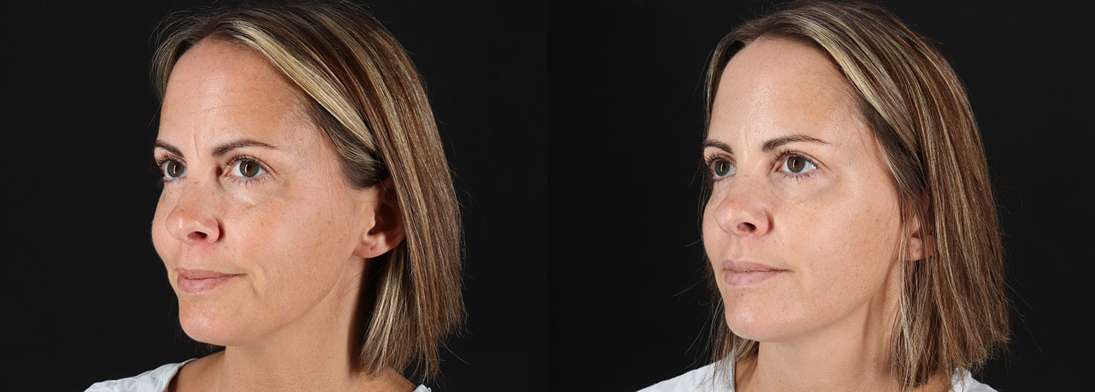 Botox-Before-and-After-photo-by-Dr.-Abigail-Rodriguez-in-Houston-TX-258578-7