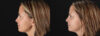 Botox® & Other Neuromodulators case #5064 slider thumbnail