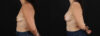 Breast Augmentation case #6497 slider thumbnail