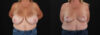 Revision Breast Surgery case #256288 slider thumbnail