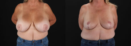 Revision Breast Surgery case #256288