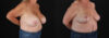 Revision Breast Surgery case #256288 slider thumbnail