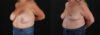 Revision Breast Surgery case #256288 slider thumbnail