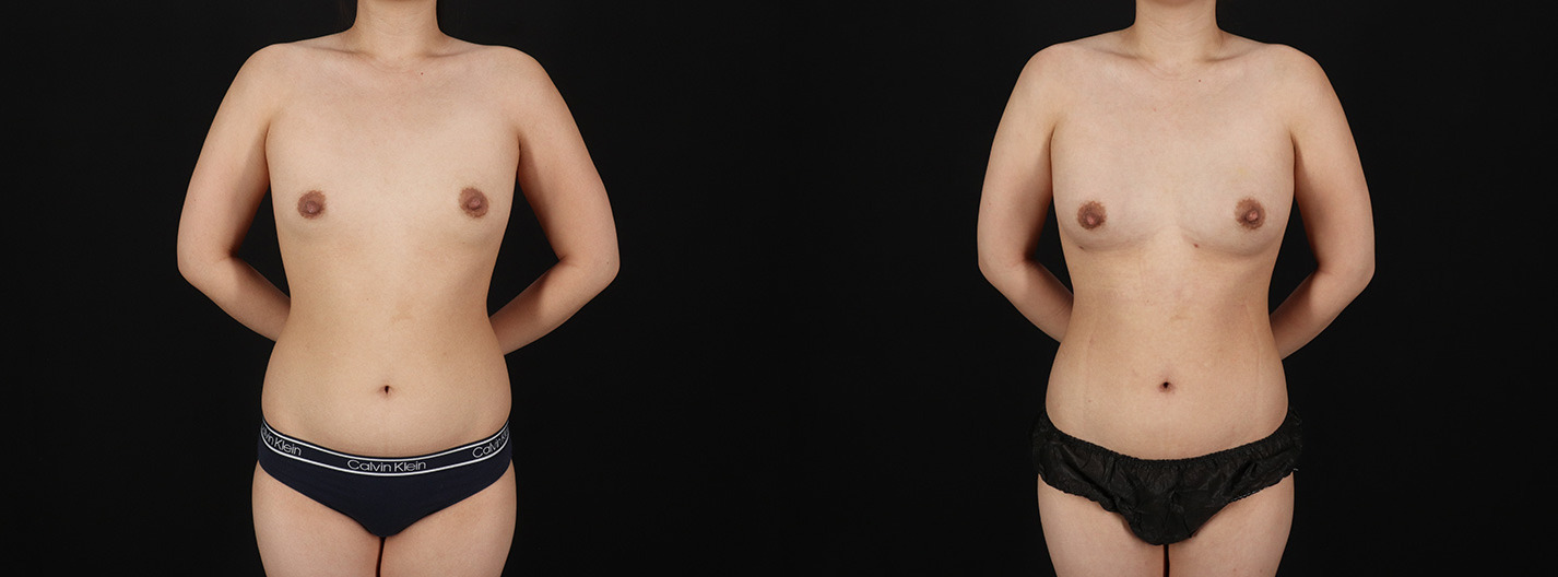 Fat-Grafting-to-the-Breast-Before-and-After-Photo-by-Dr.-Erika-A.-Sato-in-Houston-TX-1