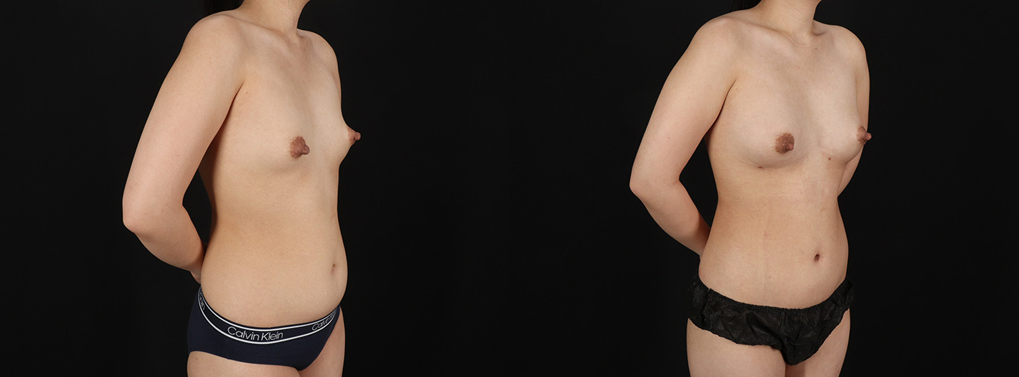 Fat-Grafting-to-the-Breast-Before-and-After-Photo-by-Dr.-Erika-A.-Sato-in-Houston-TX-2