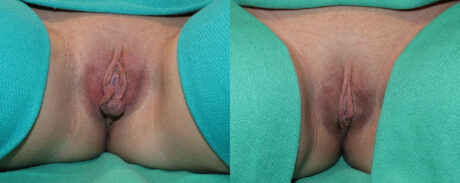 Labiaplasty case #5796