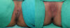 Labiaplasty case #5797 slider thumbnail