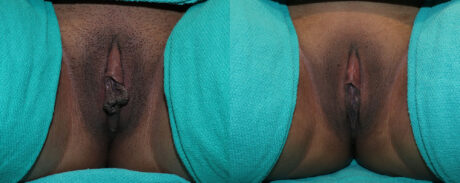 Labiaplasty case #5800