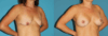 Breast Lift with Implants case #7872 slider thumbnail