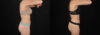 Liposuction case #6236 slider thumbnail