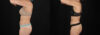 Liposuction case #6236 slider thumbnail