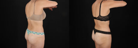 Liposuction case #6236