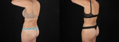 Liposuction case #6236