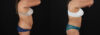 Tummy Tuck case #7778 slider thumbnail