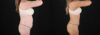 Tummy Tuck case #7779 slider thumbnail