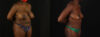 Tummy Tuck case #7780 slider thumbnail