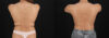 Breast Augmentation case #6462 slider thumbnail