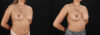 Breast Augmentation case #6462 slider thumbnail