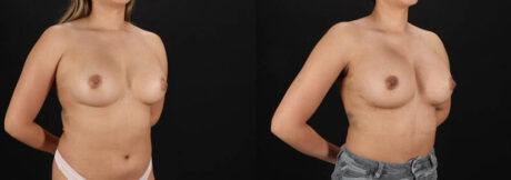 Breast Augmentation case #6462