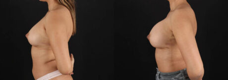 Breast Augmentation case #6462
