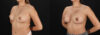 Breast Augmentation case #6462 slider thumbnail