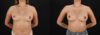 Breast Augmentation case #6462 slider thumbnail