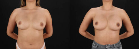 Breast Augmentation case #6462