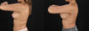 Breast Augmentation case #6462 slider thumbnail