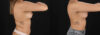 Breast Augmentation case #6462 slider thumbnail