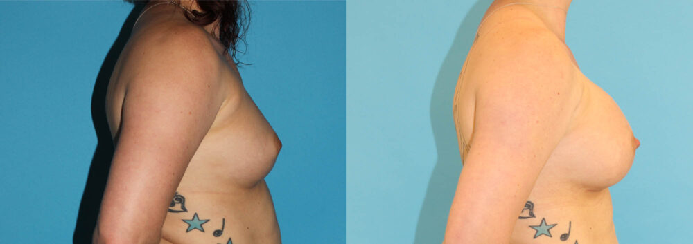 Breast Augmentation case #5649