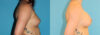 Breast Augmentation case #5649 slider thumbnail