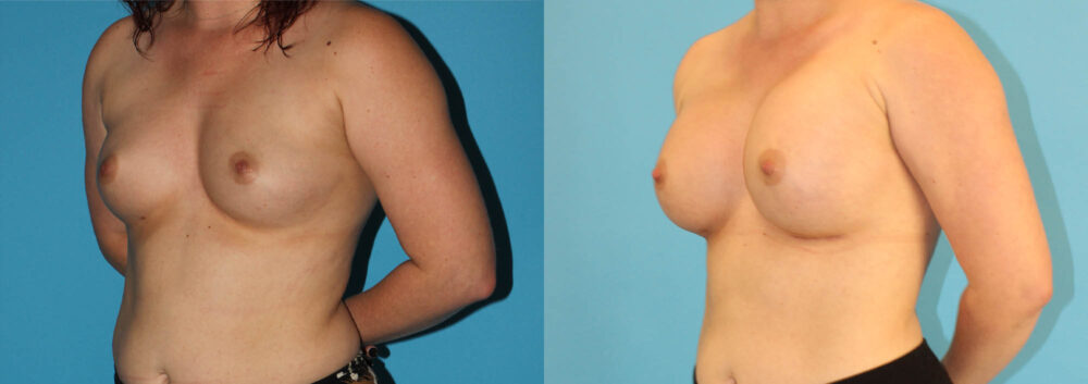 Breast Augmentation case #5649