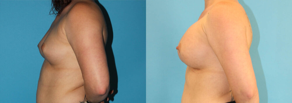 Breast Augmentation case #5649