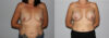 Breast Augmentation case #5622 slider thumbnail
