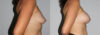 Breast Augmentation case #5622 slider thumbnail